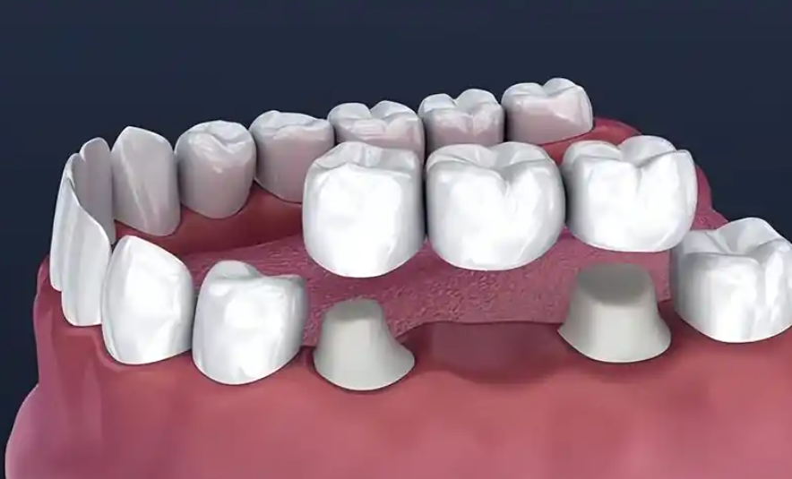 种植牙vs固定义齿vs活动假牙:详解3大修复方案差异!